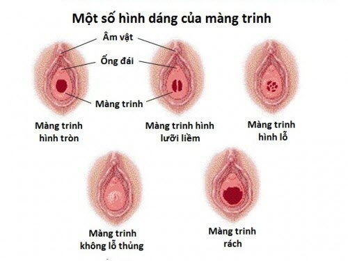 Bạn có thể tự nhận biết màng trinh còn hay mất tại nhà