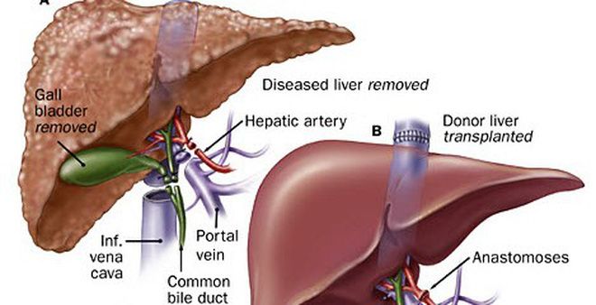 Những Dấu Hiệu Chứng tỏ bạn Có Nguy cơ mắc bệnh gan