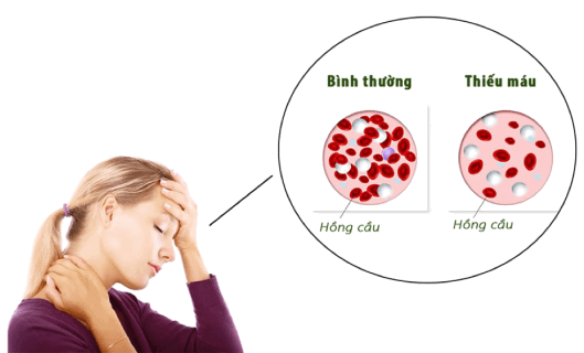 thiếu máu khiến rụng tóc nhiều