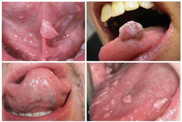 Một số hình ảnh về bệnh sùi mào gà ở vùng miệng