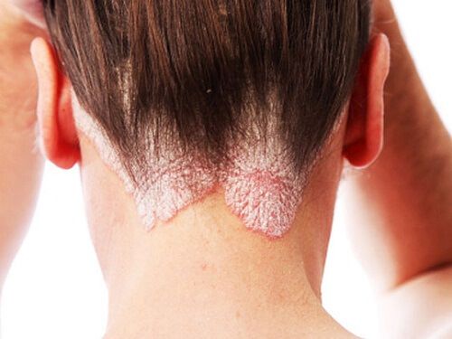 Bệnh sùi mào gà có thể xuất hiện ở nhiều vùng da trên cơ thể