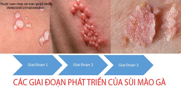 Dấu hiệu sùi mào gà qua các giai đoạn