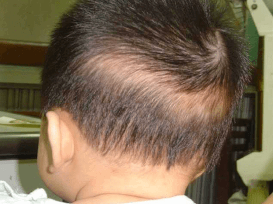 Rụng tóc từng mảng ở trẻ em là báo hiệu về sức khỏe của trẻ