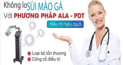 Điều trị sùi mào gà bằng phương pháp ALA – PDT